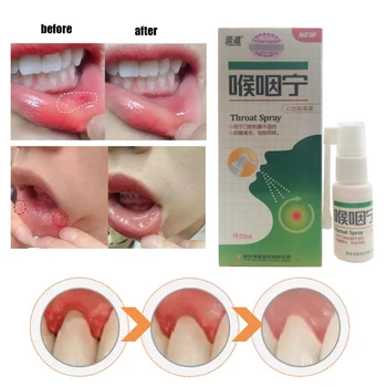 1pcs Antibakterijska Ustna Spray Ustne Razjede Toothache Razjede Pharyngitis Slab Zadah Grlo, Vnetje Zdravljenje